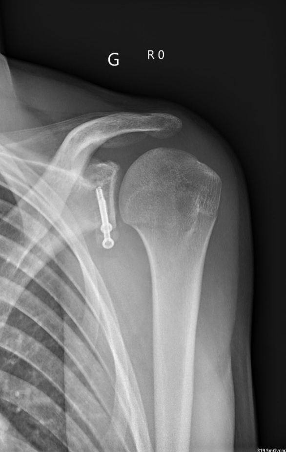 Radiographie post-opératoire butée d'épaule